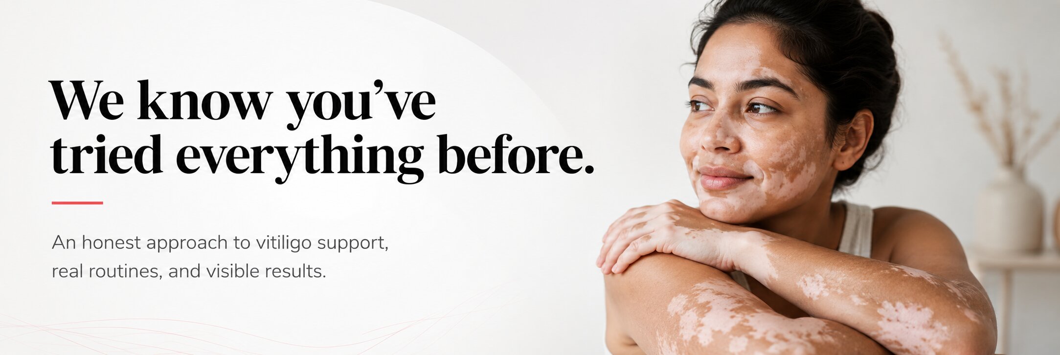 Vitiligo Treatment i have tried everything