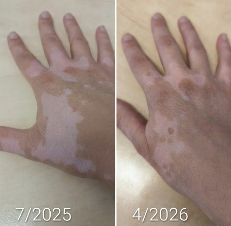 Vitistop Gel and light treatment results on hands