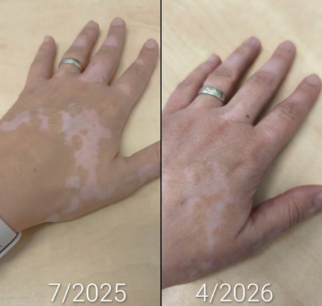 Visible repigmentation progress on hands