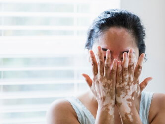 Factors affecting the treatment of vitiligo