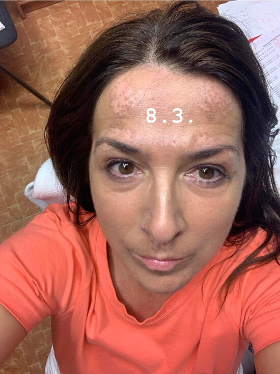 March 8 vitiligo before after photo