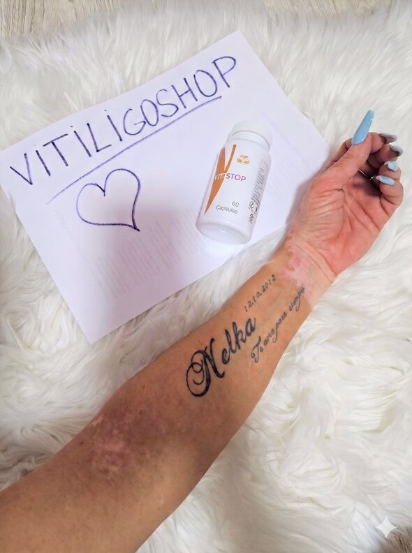Vitistop capsules vitiligo successful treatment before after photos