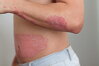 Not every single white spot is VITILIGO | Vitiligoshop.net