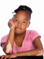 Vitiligo in children