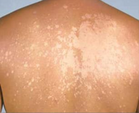 Other pigmentary disorders of the skin