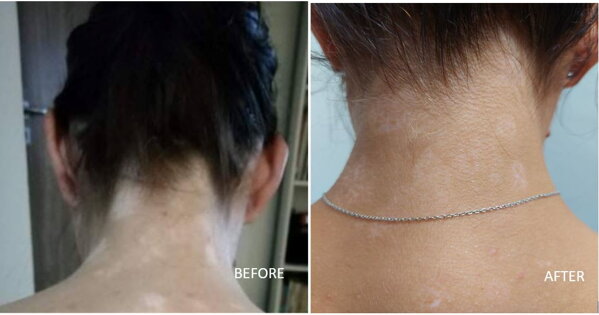 Vitiligo at the back of the neck