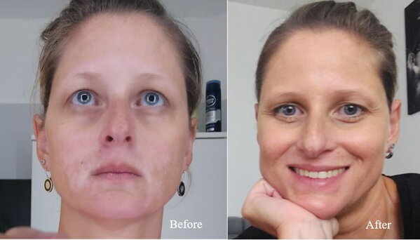 Facial vitiligo before and after treatment