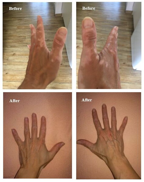 Vitiligo on the hands before and after
