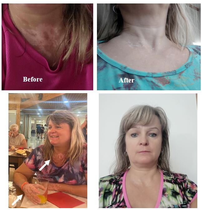 Vitiligo on her neck and chest – Jane V., VitiligoShop customer