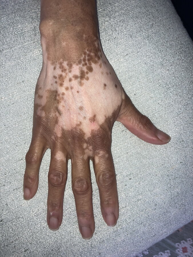 Pigment islands on the back of her hand – Norma, VitiligoShop customer
