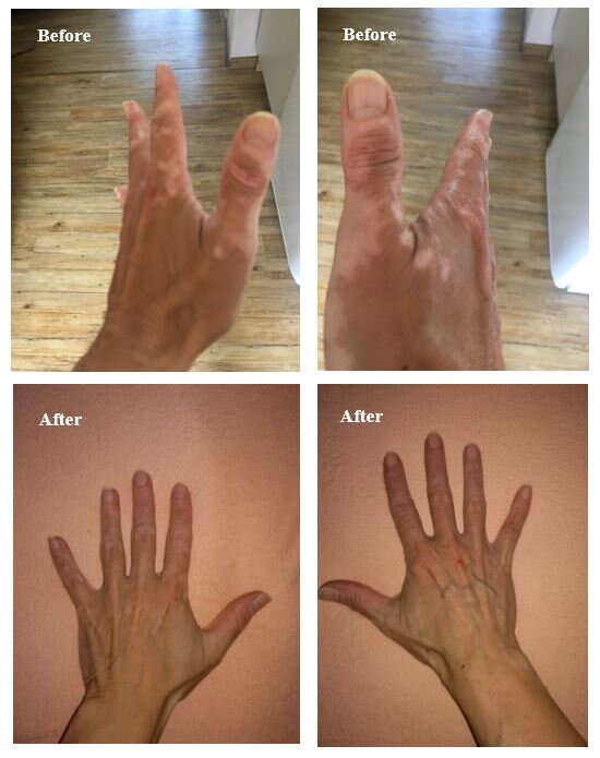 Vitiligo on hands before and after – Petra K., VitiligoShop customer