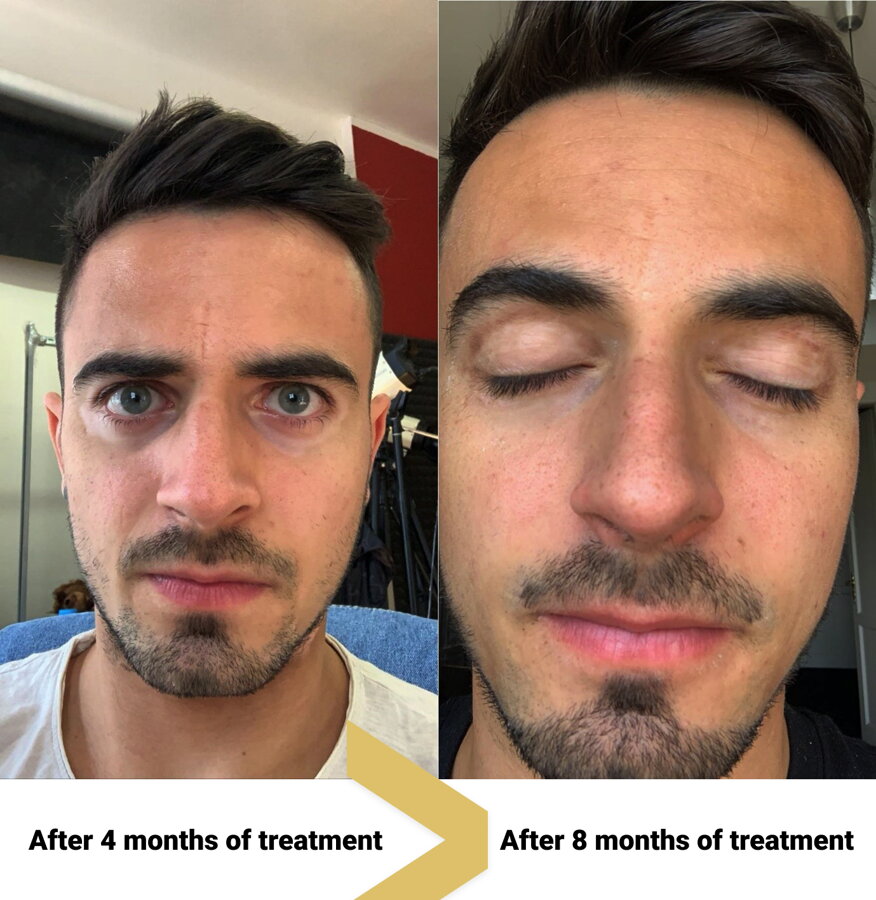 Vitiligo on his face after 4 and 8 months – Peter, VitiligoShop customer