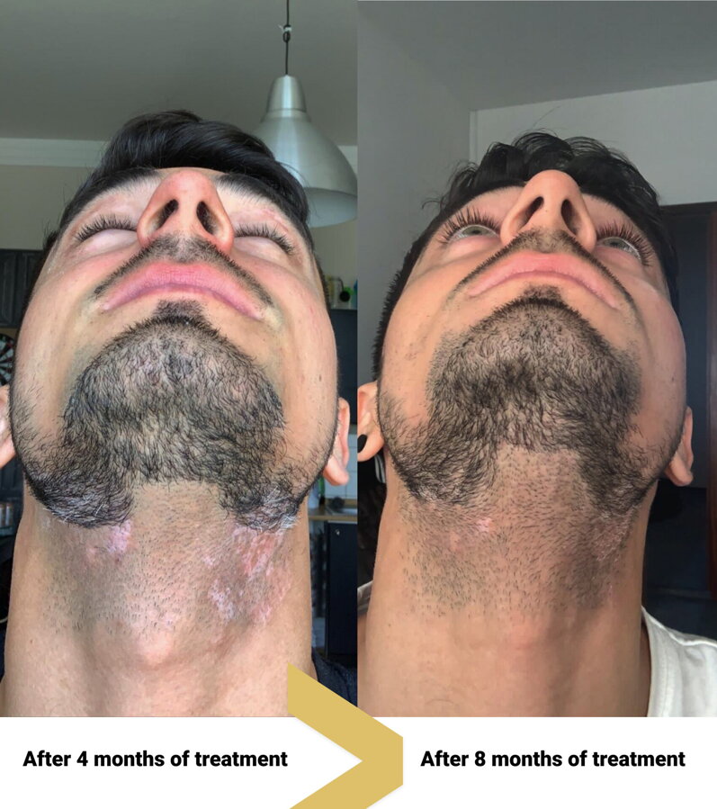 Vitiligo on his neck before and after – Peter, VitiligoShop customer